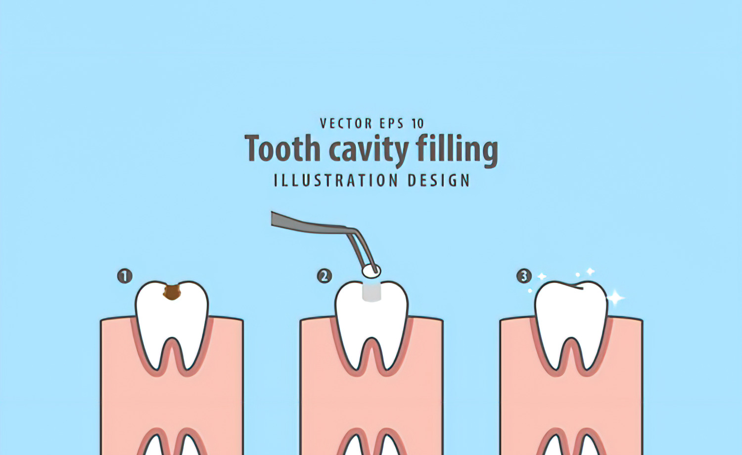 How to Choose Dental Fill Material Fit You?