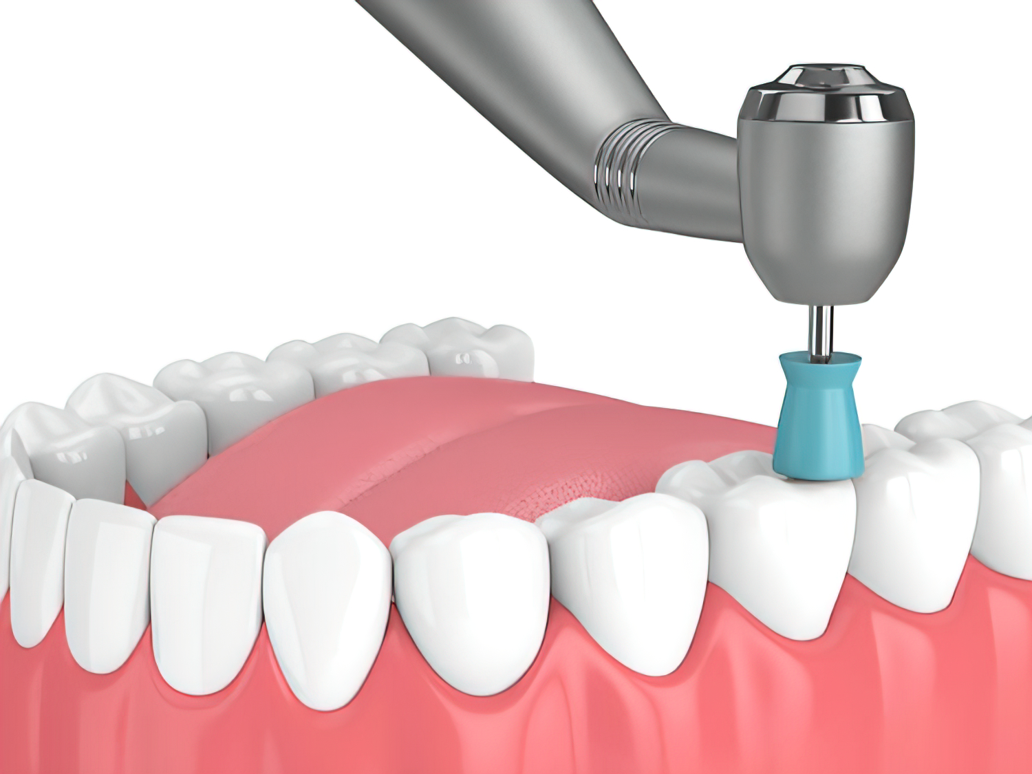 Frequently Asked Questions About Prophy Cups