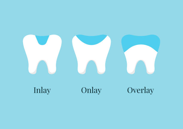 The Procedure for Inlay and Onlay Preparation