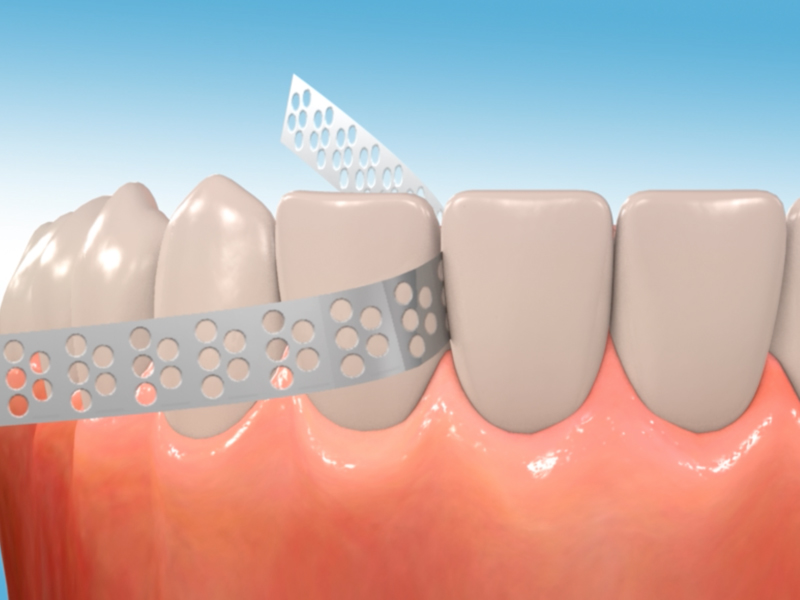 Process and Advantages of Interproximal Reduction (IPR)