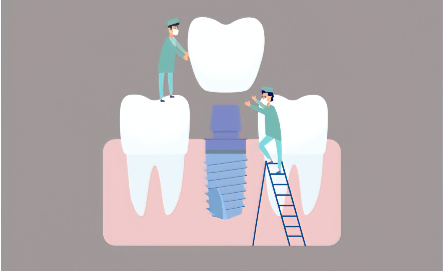 What You Need to Know about the Dental Implants?