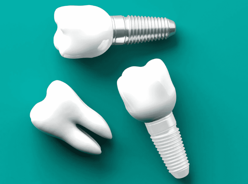 Dental Implant Materials: Comparing Titanium and Zirconia Implants