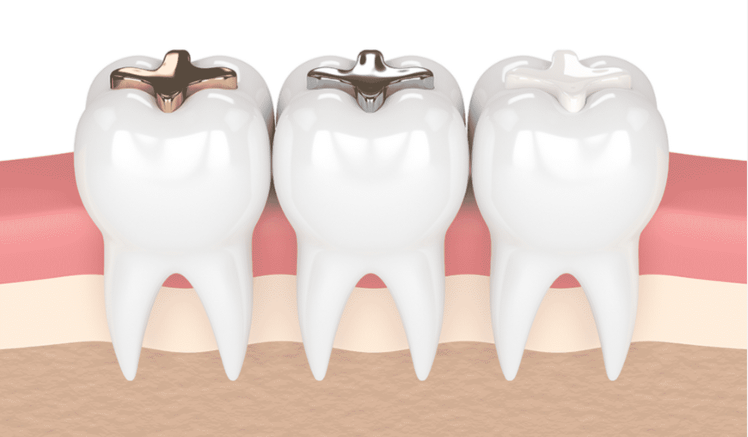 The Essential Guide to Dental Fillings: Types, Procedures, and Advancements