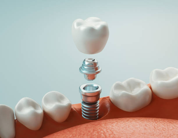 The Future of Dental Implants: How Technology is Revolutionizing Tooth Replacement