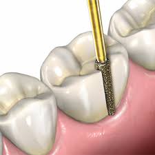 Diamond burs for dental procedures