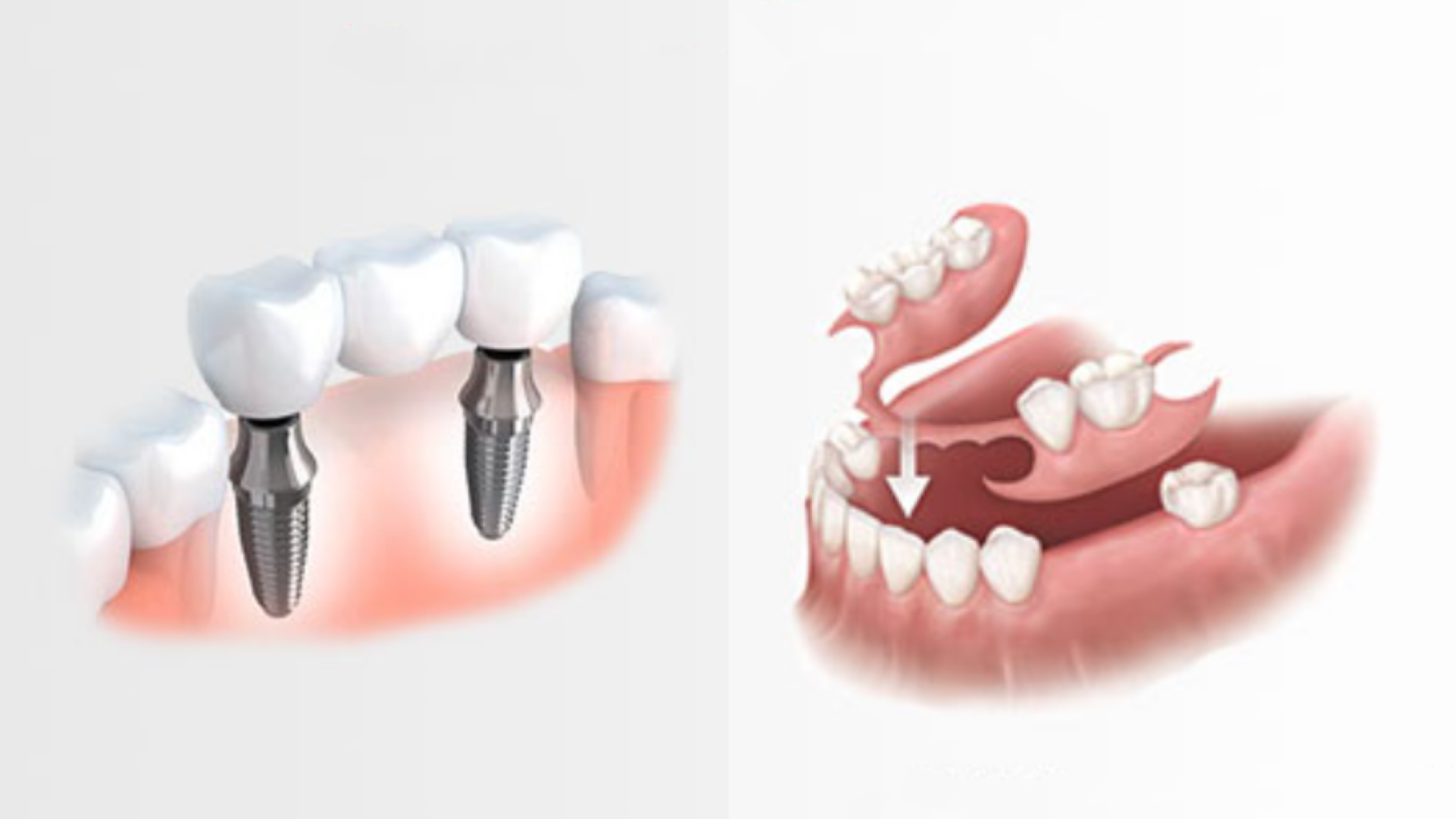 Flexsoft Partial Dentures vs. Implant-Supported Dentures