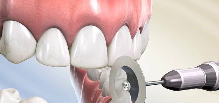 The Differences Between Diamond Discs, Stainless Steel Discs, and Stone Discs in Dental Laboratories