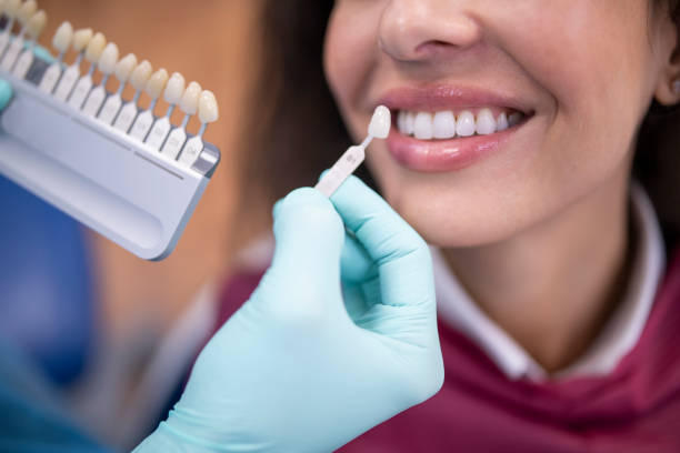 The Importance of Porcelain Veneer Preparation
