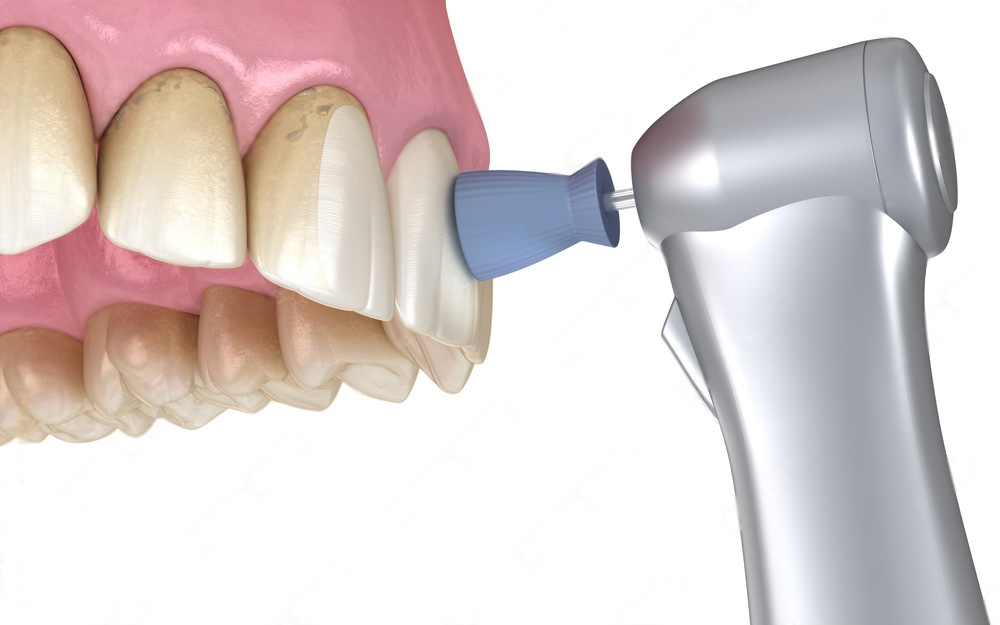 The Benefits of Using a Prophy Polisher for Dental Hygiene