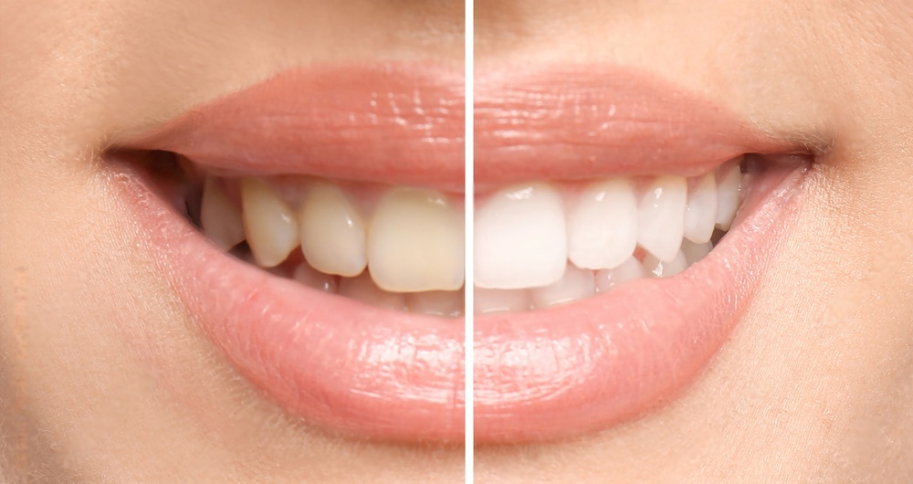 Can Prophy Polishing Help Whiten Your Teeth