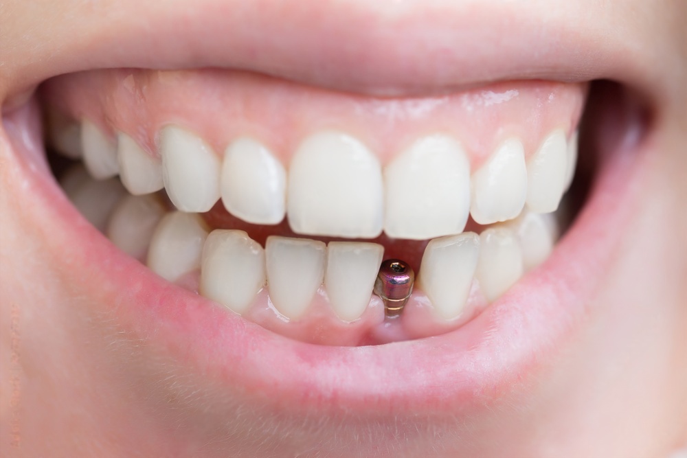 Can Dental Implants Improve Your Smile