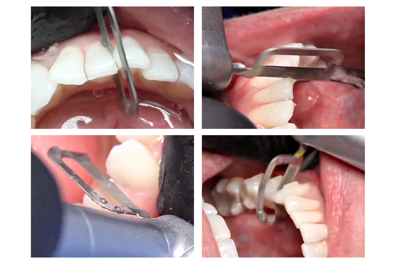 Diamond ortho strips step-by-step usage guide
