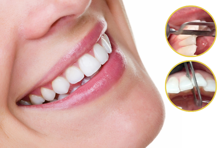 Complete Guide to Interproximal Enamel Reduction (IPR) Kits: Avoid 5 Common Mistakes and Boost Orthodontic Treatment Efficiency
